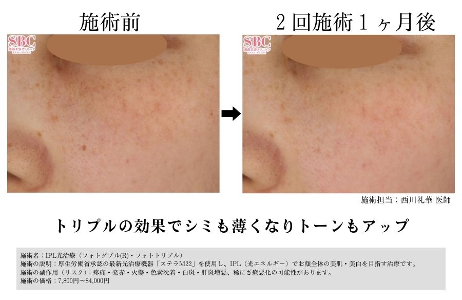 フォトトリプル